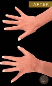 After Image: Case #6635 – Fat transfer to hands - front