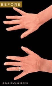 Before Image: Case #6635 – Fat transfer to hands - front