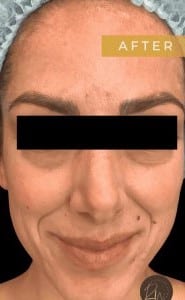 After Image: Case #6613 –  Halo Fusion for Melasma and Scarring - front
