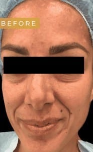 Before Image: Case #6613 –  Halo Fusion for Melasma and Scarring - front