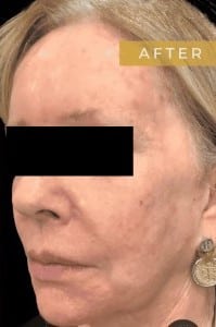 After Image: Case #6643 – Trifecta Profound - left-front-oblique