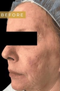 Before Image: Case #6643 – Trifecta Profound - left-front-oblique