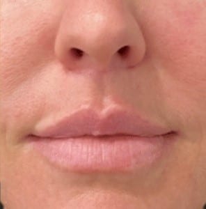 After Image: Case #6871 – Lip lift - front
