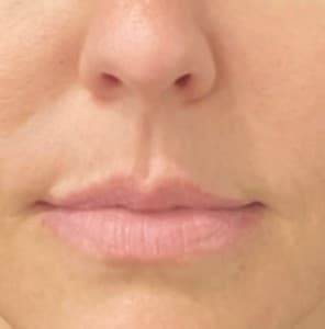 Before Image: Case #6871 – Lip lift - front