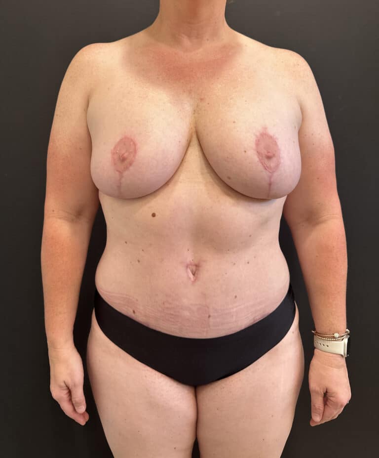 After Image: Case #8231 – Mommy Makeover - front
