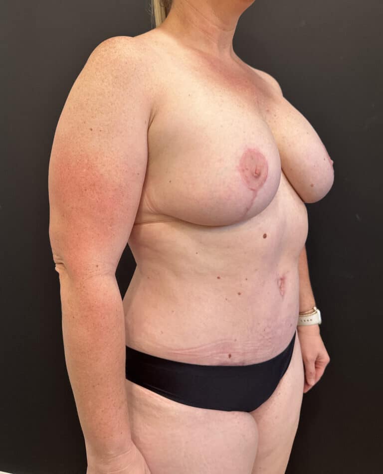 After Image: Case #8231 – Mommy Makeover - right-front-oblique