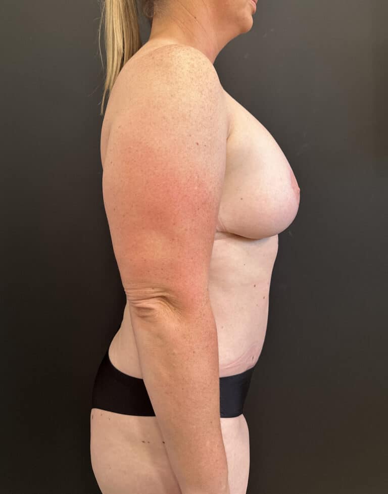 After Image: Case #8231 – Mommy Makeover - right-side