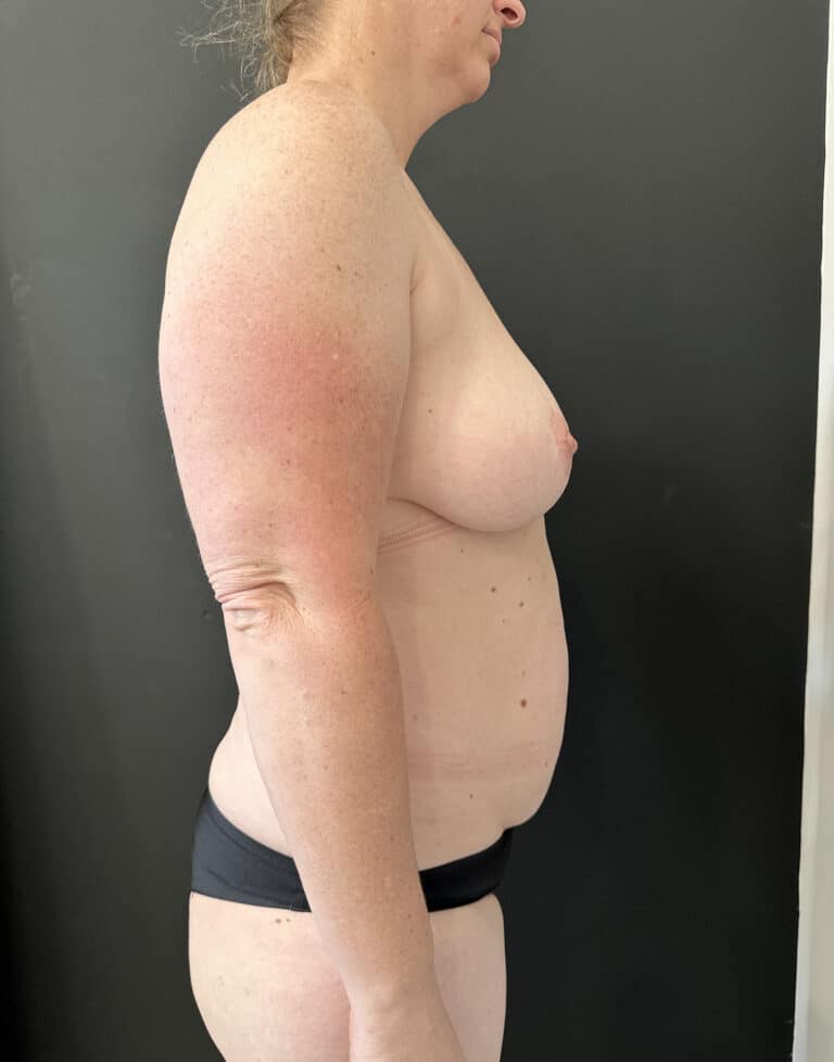 Before Image: Case #8231 – Mommy Makeover - right-side