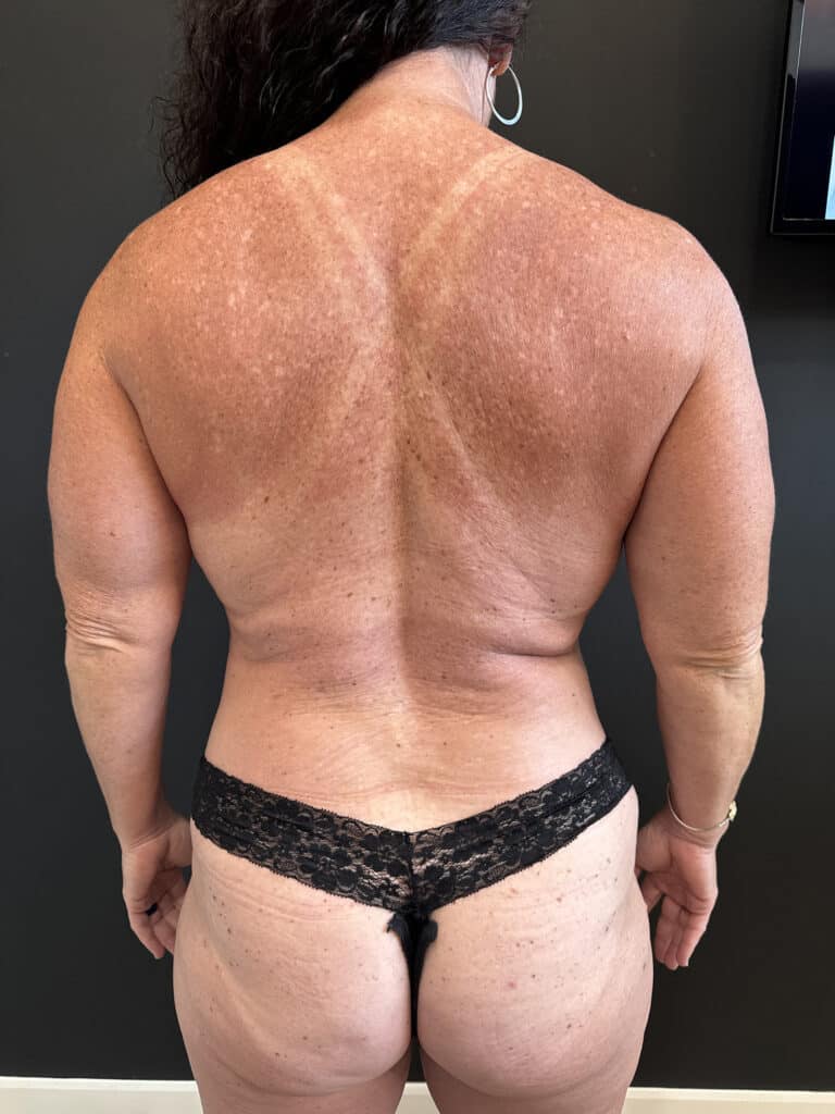 After Image: Case #8240 – Tummy Tuck, Mommy Makeover, Safelipo, Breast Implant Exchange - back