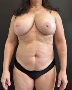Before Image: Case #8240 – Tummy Tuck, Mommy Makeover, Safelipo, Breast Implant Exchange