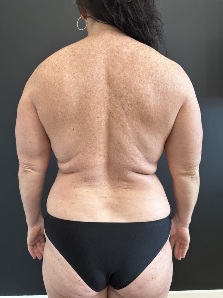 Before Image: Case #8240 – Tummy Tuck, Mommy Makeover, Safelipo, Breast Implant Exchange - back