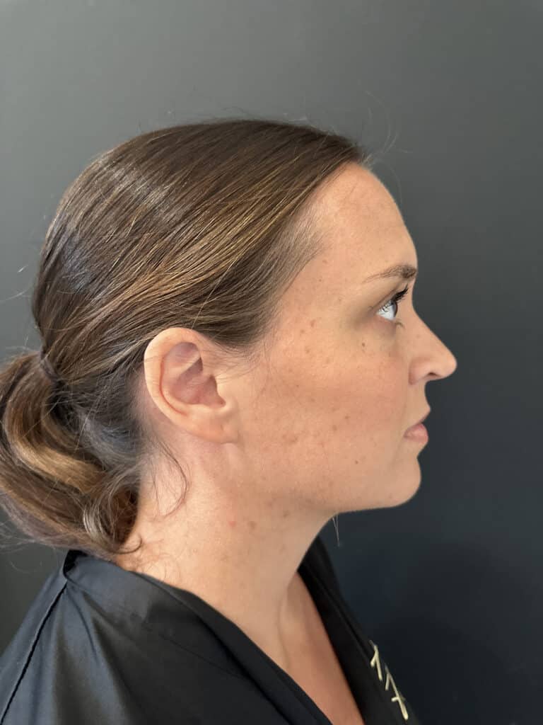 After Image: Case #8248 – Mommy Makeover, SAFELipo of Neck, Breast Aug w/ Lift - right-side