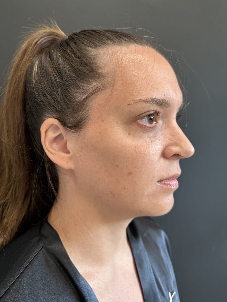 Before Image: Case #8248 – Mommy Makeover, SAFELipo of Neck, Breast Aug w/ Lift - right-front-oblique
