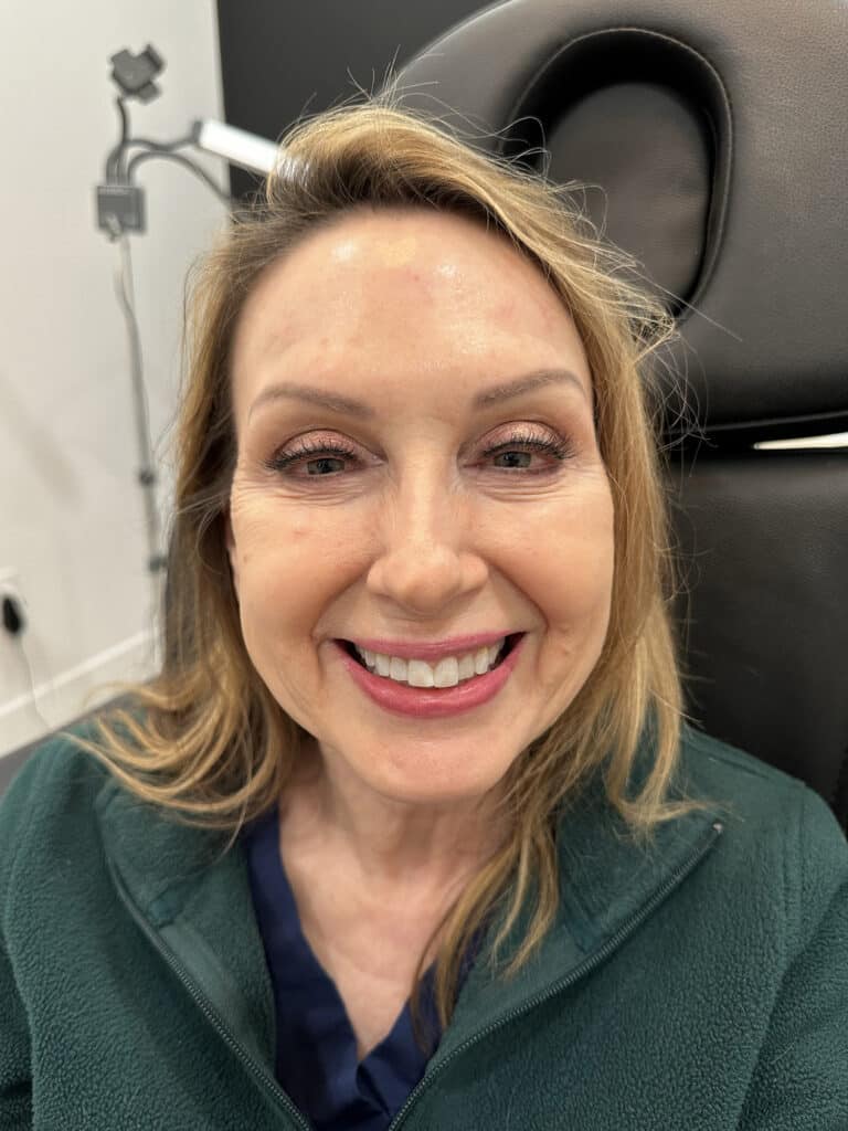 After Image: Case #8312 – Botox - front