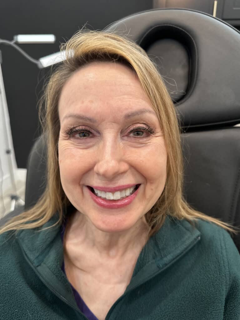 Before Image: Case #8312 – Botox - front