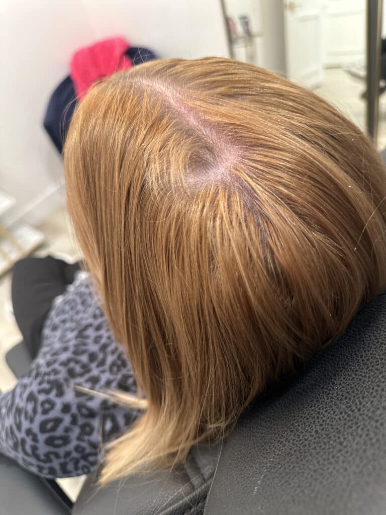 After Image: Case #8330 – PRF Hair Restoration and Keravive Treatment - left-back-oblique