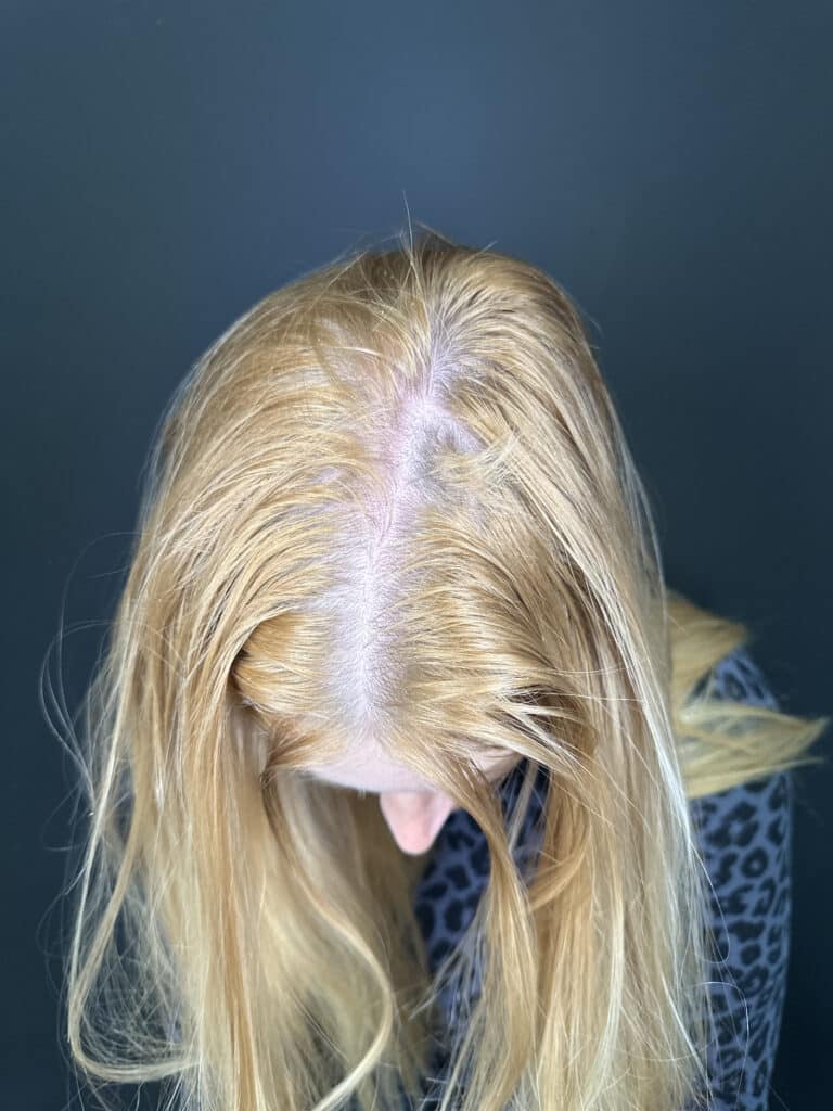 After Image: Case #8330 – PRF Hair Restoration and Keravive Treatment - front