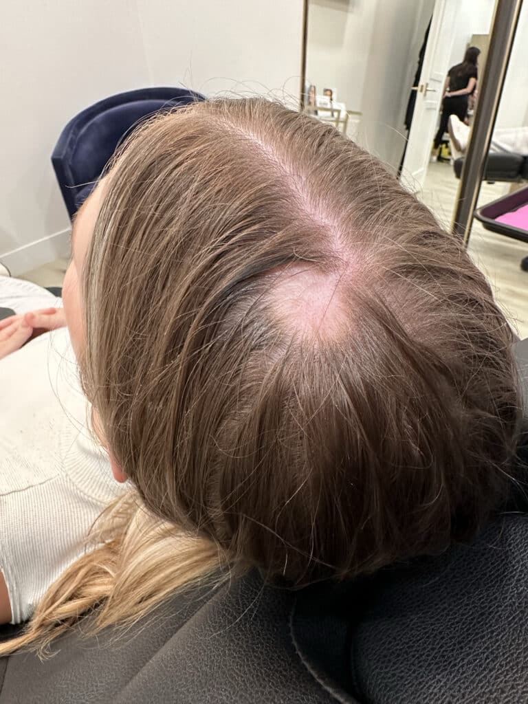 Before Image: Case #8330 – PRF Hair Restoration and Keravive Treatment - left-back-oblique