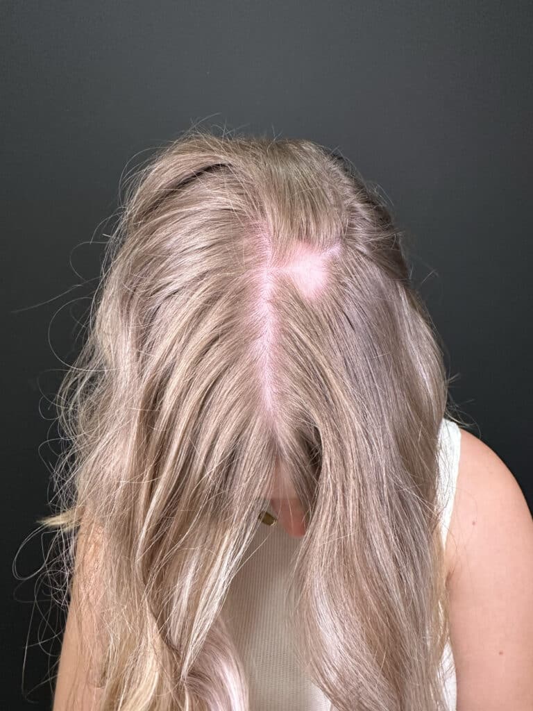 Before Image: Case #8330 – PRF Hair Restoration and Keravive Treatment - front
