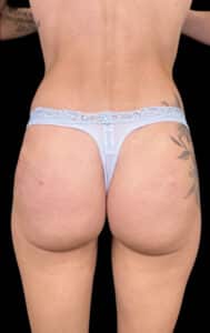 After Image: Case #8336 – Non Surgical BBL