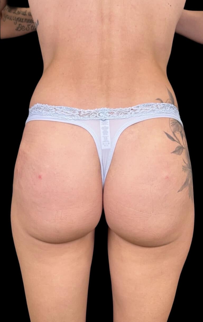 After Image: Case #8336 – Non Surgical BBL - back
