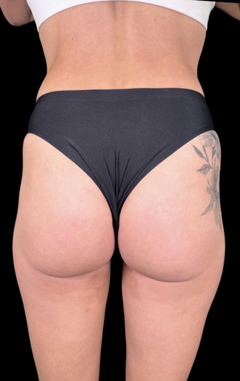 Before Image: Case #8336 – Non Surgical BBL - back
