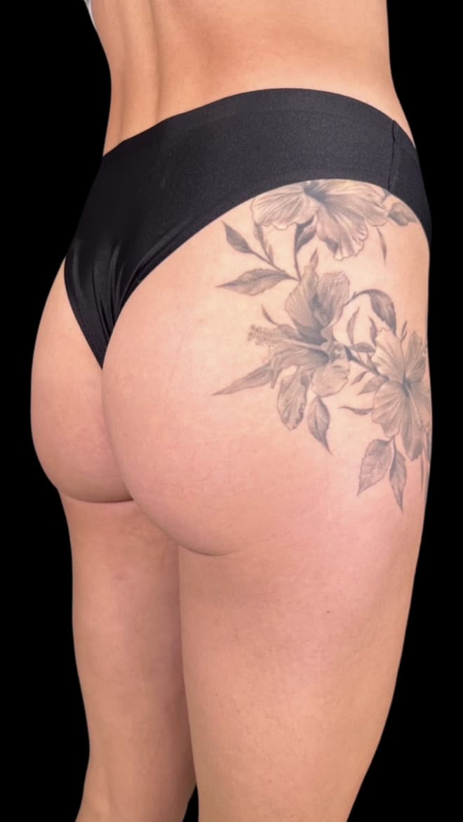 Before Image: Case #8336 – Non Surgical BBL - right-back-oblique