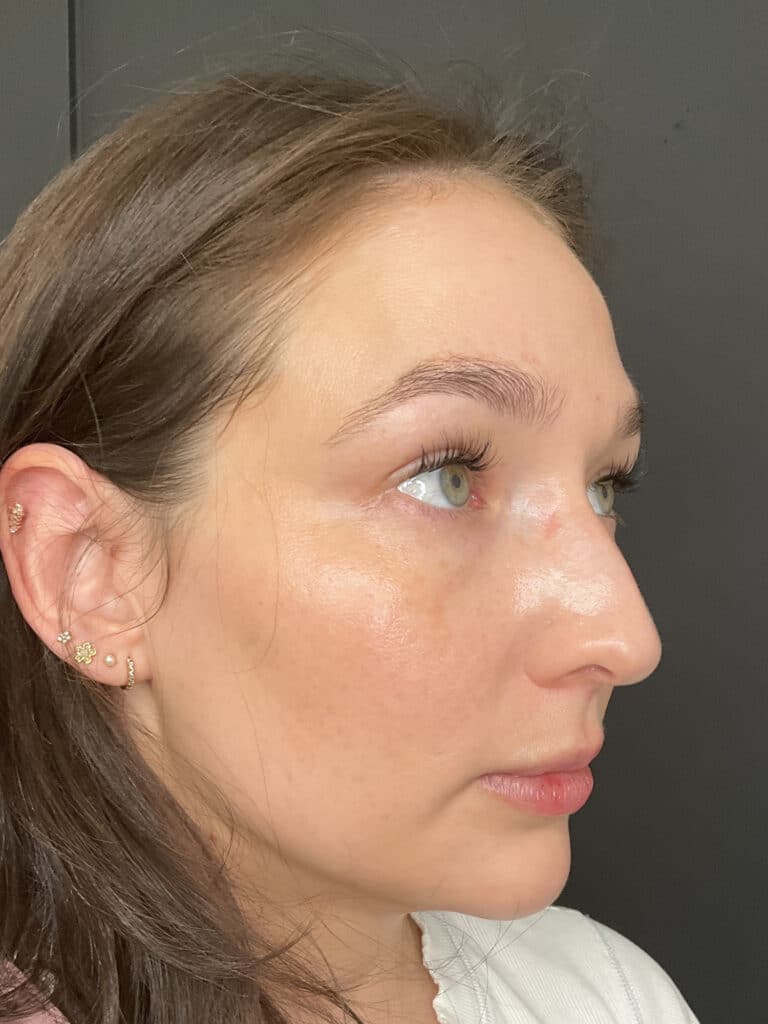 After Image: Case #8373 – SAFELipo of neck, buccal fat removal, Sciton BBL Treatment - front