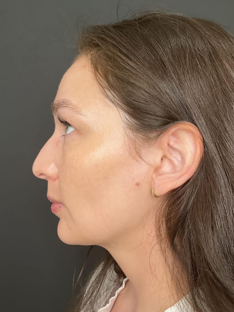 After Image: Case #8373 – SAFELipo of neck, buccal fat removal, Sciton BBL Treatment - left-side