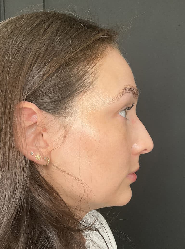 After Image: Case #8373 – SAFELipo of neck, buccal fat removal, Sciton BBL Treatment - right-side