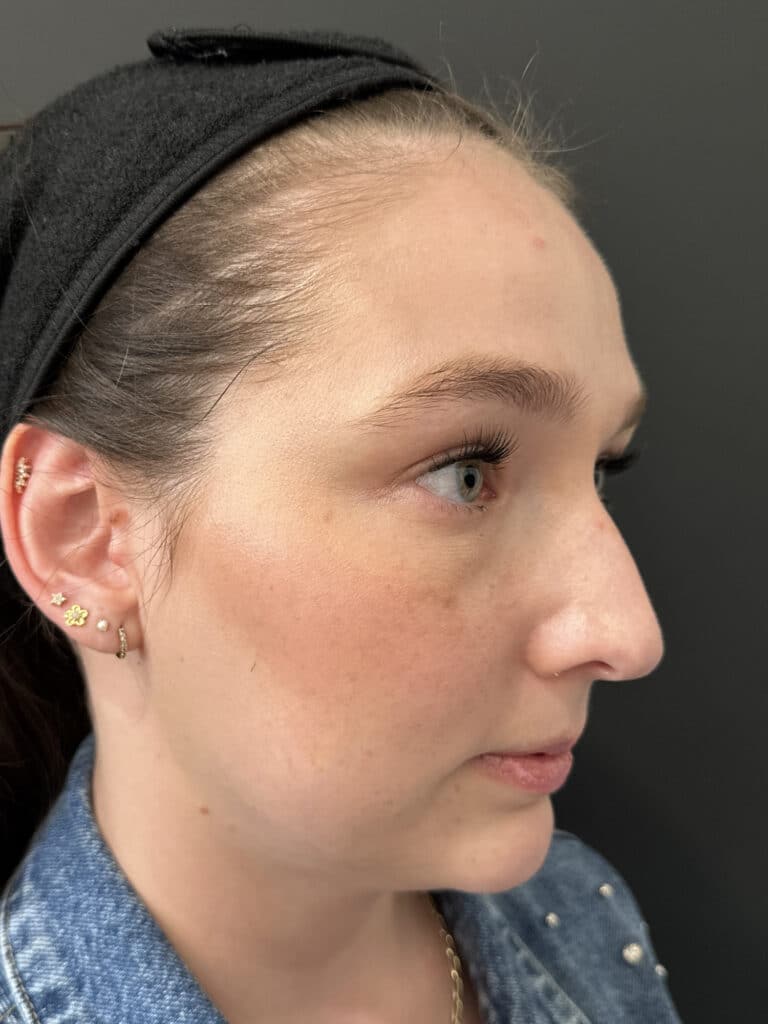 Before Image: Case #8373 – SAFELipo of neck, buccal fat removal, Sciton BBL Treatment - front