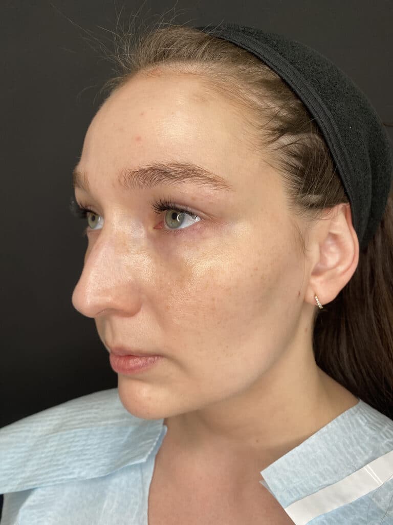 Before Image: Case #8342 – Sciton BBL - left-front-oblique