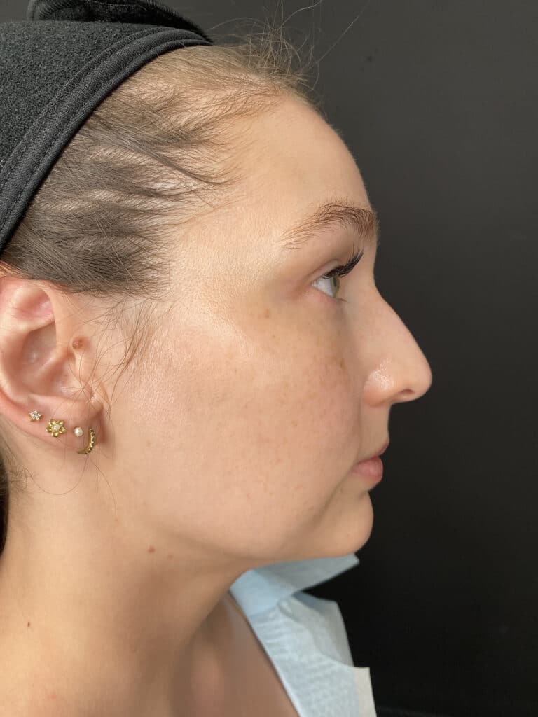 Before Image: Case #8342 – Sciton BBL - right-side