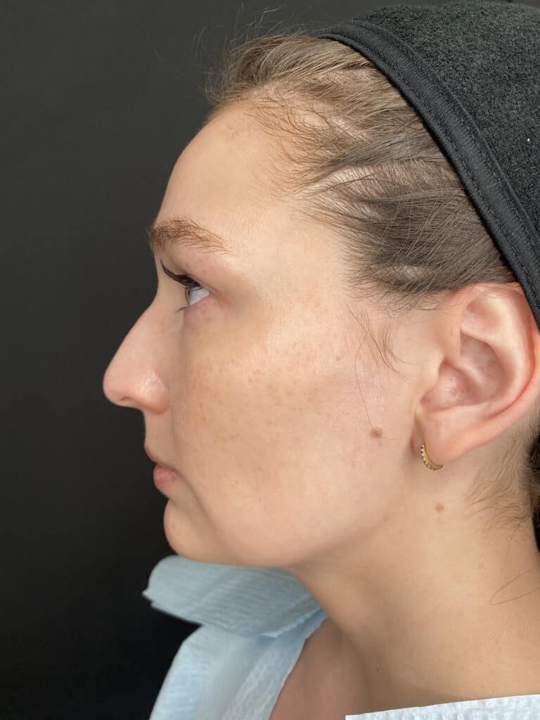 Before Image: Case #8342 – Sciton BBL - left-side