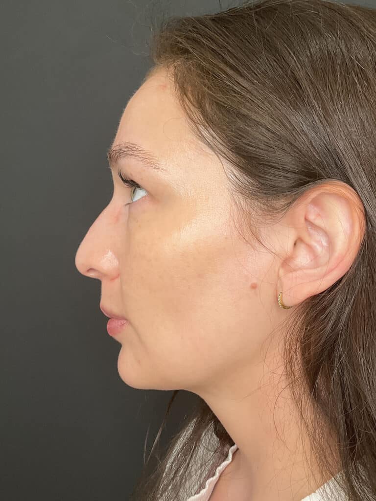 After Image: Case #8342 – Sciton BBL - left-side