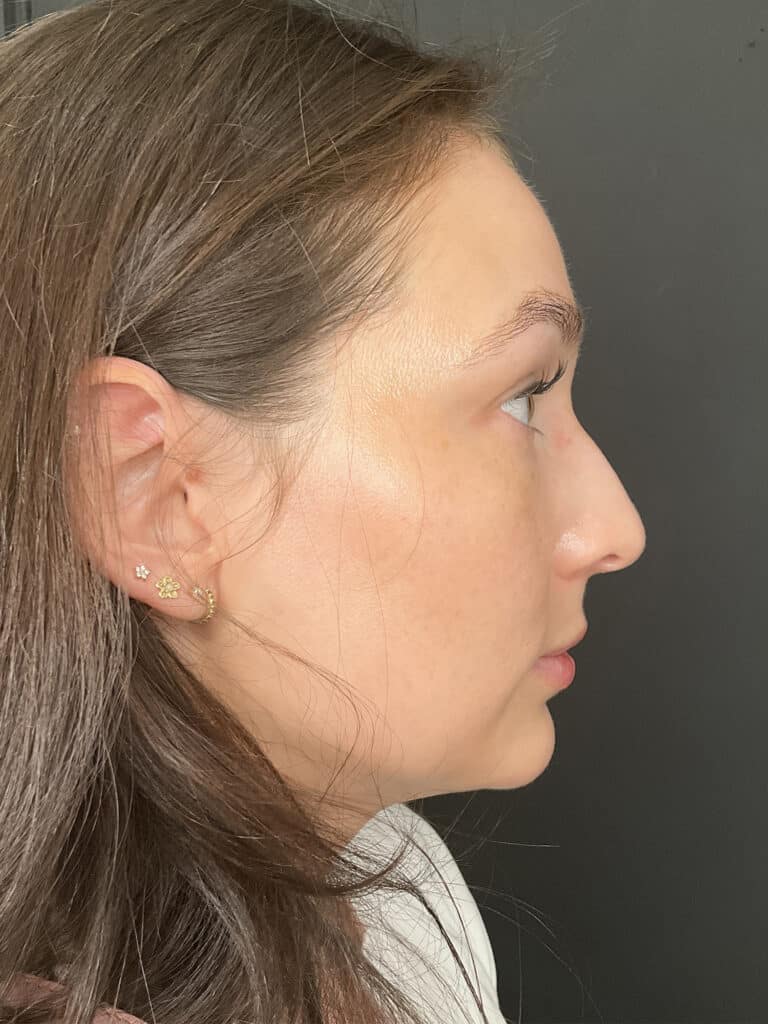After Image: Case #8342 – Sciton BBL - right-side