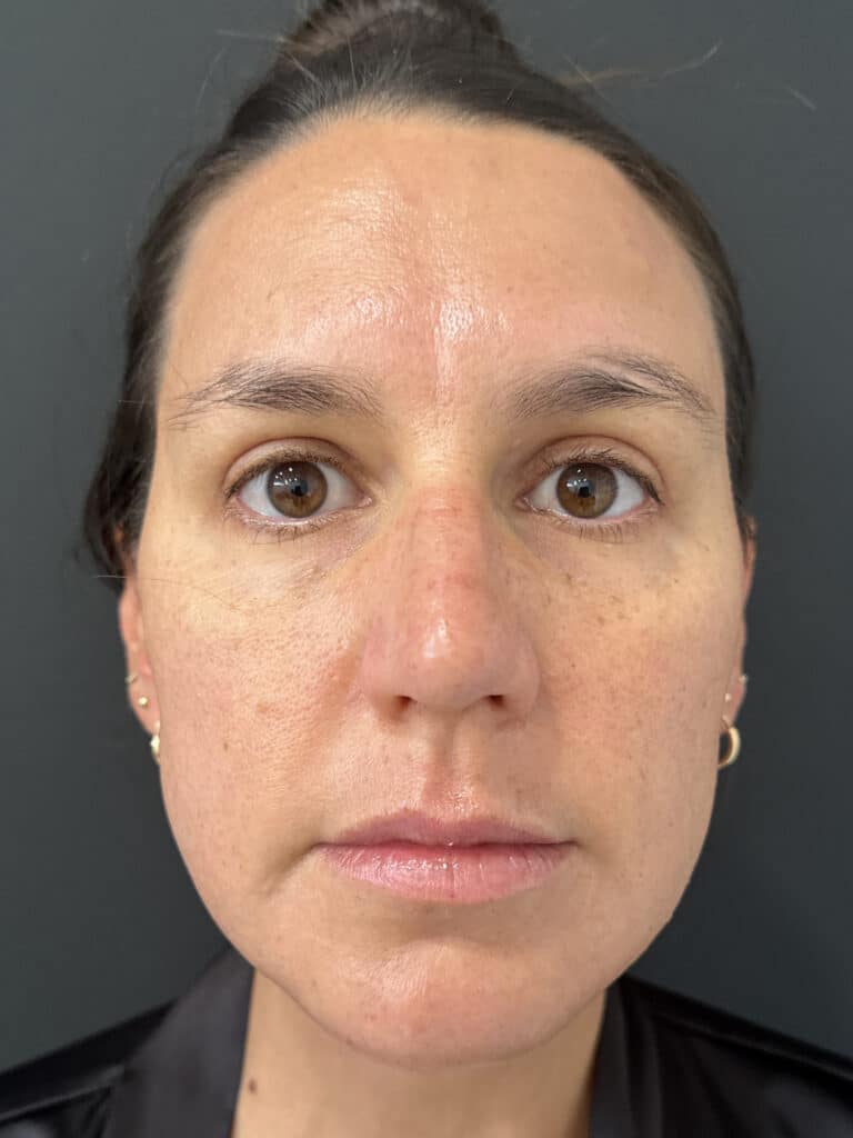 After Image: Case #8392 –  Upper Blepharoplasty - front