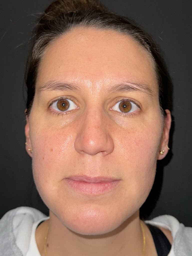 Before Image: Case #8392 –  Upper Blepharoplasty - front