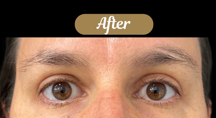 After Image: Case #8392 –  Upper Blepharoplasty - front