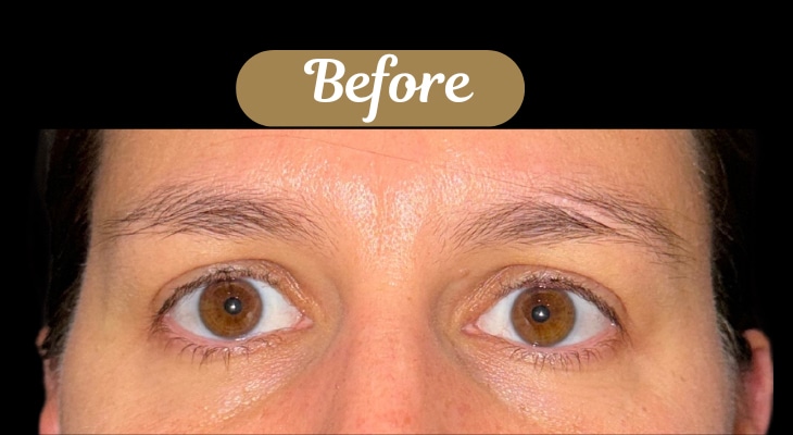 Before Image: Case #8392 –  Upper Blepharoplasty - front