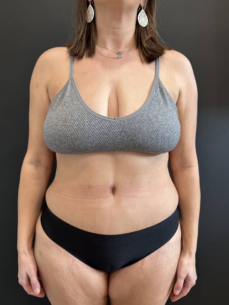After Image: Case #8423 – Extended Abdominoplasty with SAFElipo of Circ Trunk - front