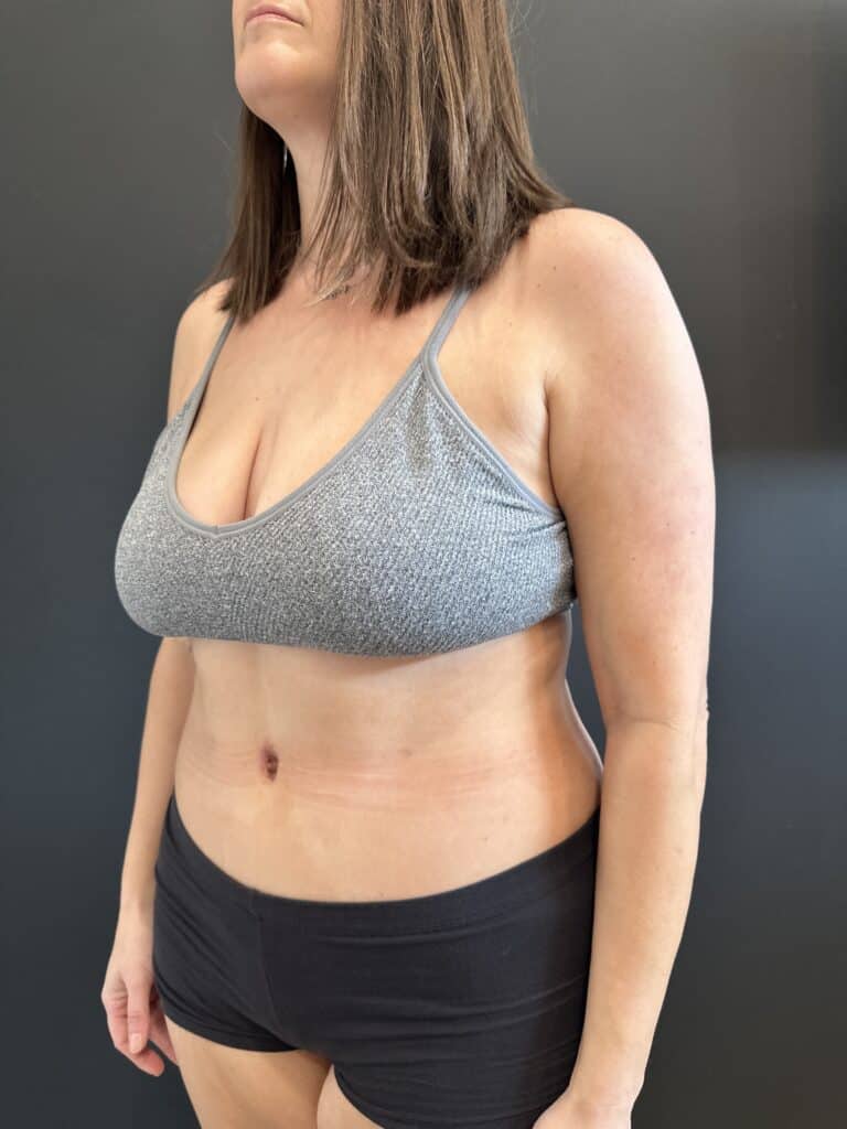 After Image: Case #8423 – Extended Abdominoplasty with SAFElipo of Circ Trunk - left-front-oblique