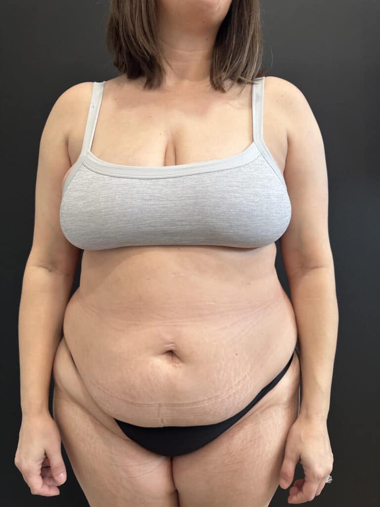 Before Image: Case #8423 – Extended Abdominoplasty with SAFElipo of Circ Trunk - front