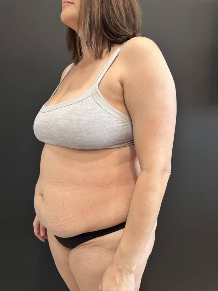 Before Image: Case #8423 – Extended Abdominoplasty with SAFElipo of Circ Trunk - left-front-oblique