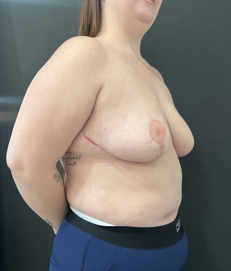 After Image: Case #8437 – Breast reduction, Breast Asymmetry - right-front-oblique