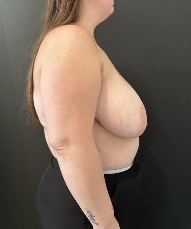 Before Image: Case #8437 – Breast reduction, Breast Asymmetry - right-side