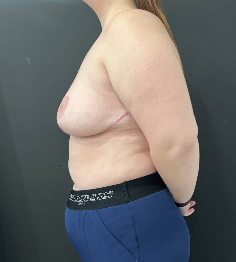 After Image: Case #8437 – Breast reduction, Breast Asymmetry - left-side