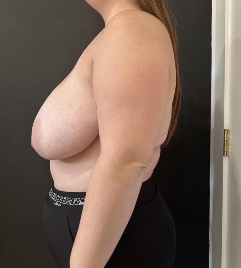 Before Image: Case #8437 – Breast reduction, Breast Asymmetry - left-side