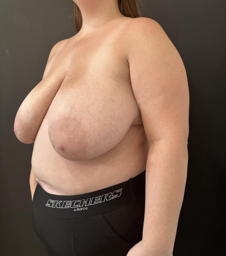 Before Image: Case #8437 – Breast reduction, Breast Asymmetry - left-front-oblique