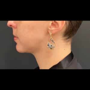 After Image: Case #8451 – Chin Implant